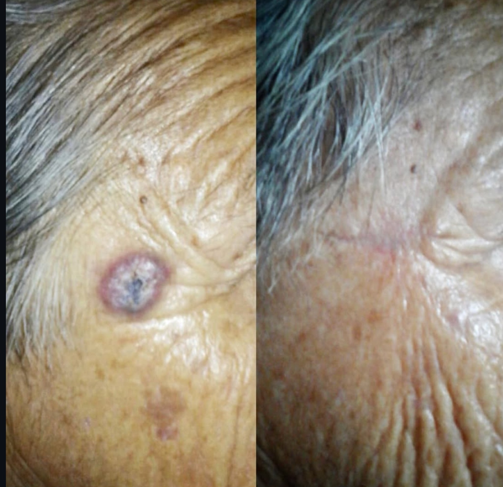 Antes y después de resección de Carcinoma Basocelular en cara