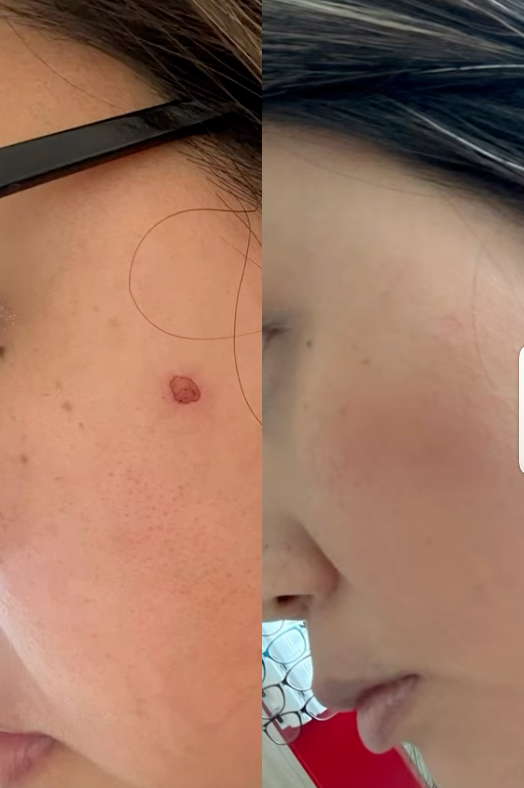 Antes y después de detección temprana de lesión sospechosa en piel