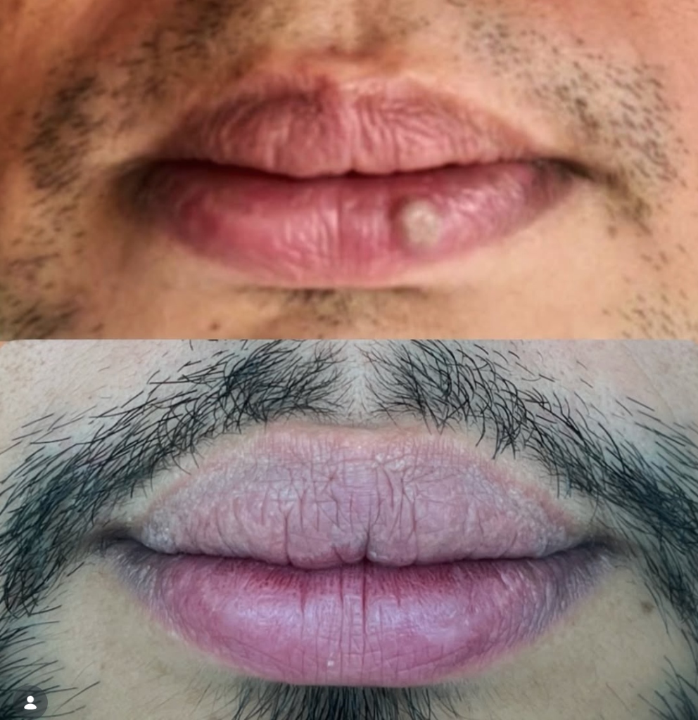 Antes y después de remoción de lesión en labio